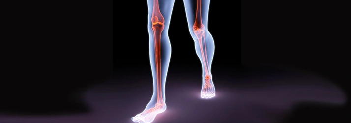 Transparent leg illustration displaying bones and joints with emphasized areas of stress and impact.